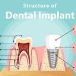 Don't Let Dental Costs Bite: Why Dental Insurance is a Must-Have