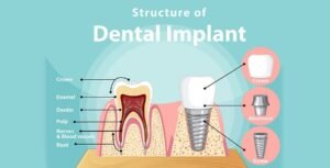 Don't Let Dental Costs Bite: Why Dental Insurance is a Must-Have